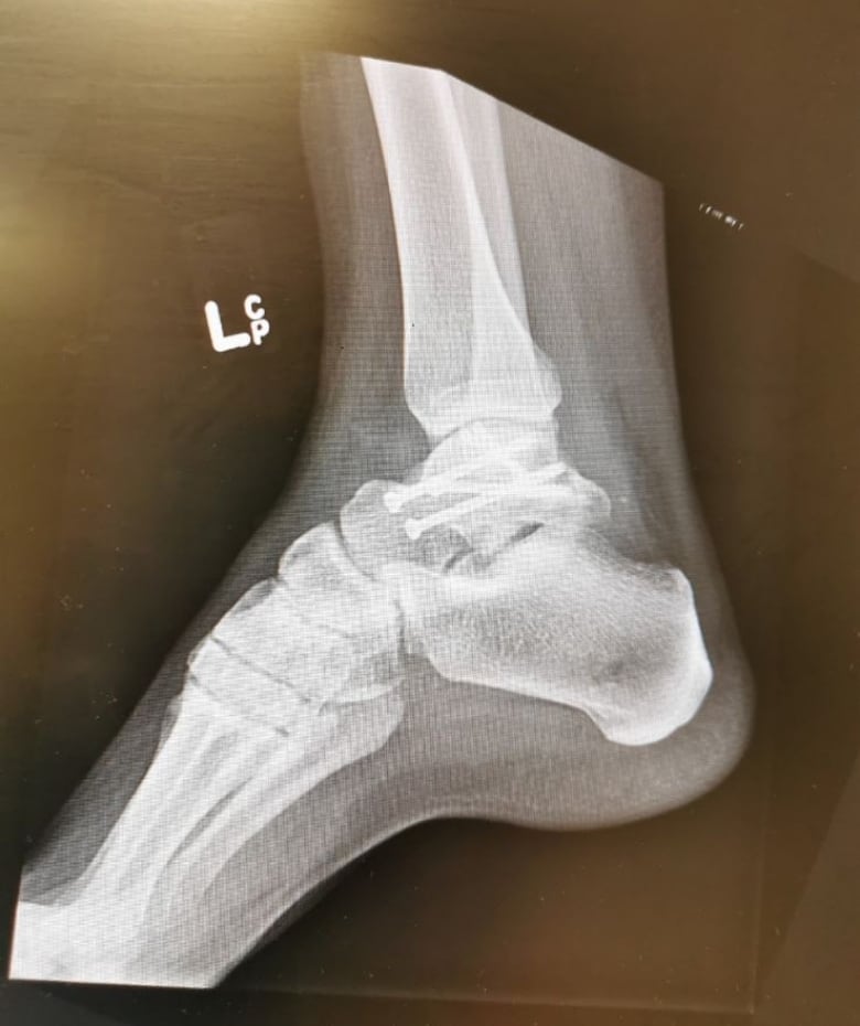 An x-ray image of a foot and ankle showing pins.