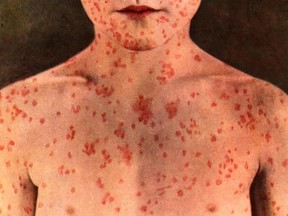 Measles Alert for Ontario Northland Bus Passengers
