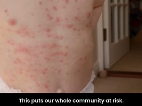 Child's chest with measles rash