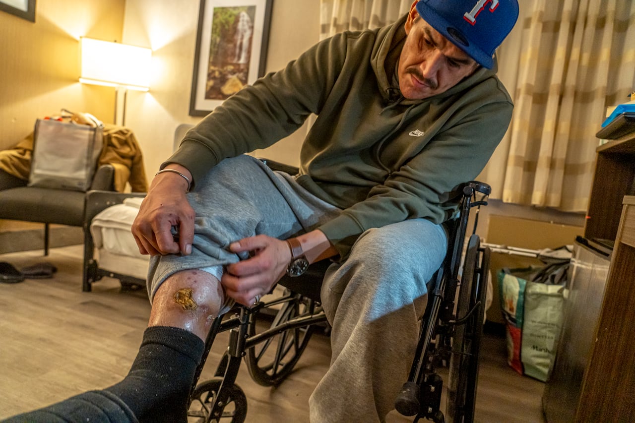 A man in a wheel chair shows a gunshot wound on his leg.