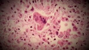 Kingston residents warned of possible measles exposure Kingston residents warned of possible measles exposure