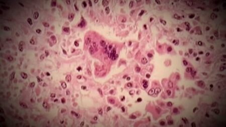 Potential Measles Risk for Kingston Residents