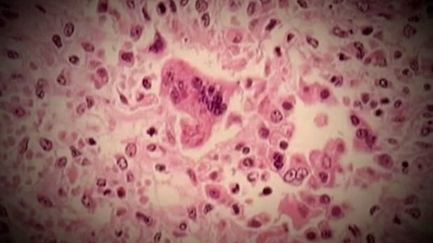 Potential Measles Risk for Kingston Residents Potential Measles Risk for Kingston Residents