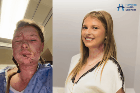 New Burn Treatment Shows Incredible Results in Canada
