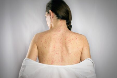Measles Alert in Newmarket and Vaughan