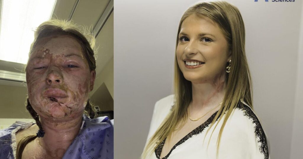 Ontario Woman Treated with Innovative Burn Therapy Ontario Woman Treated with Innovative Burn Therapy