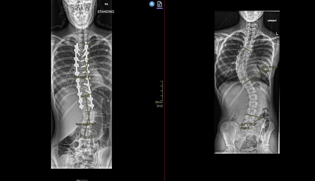 Ontario’s First Pediatric Patient Receives Robotic Spinal Surgery Ontario’s First Pediatric Patient Receives Robotic Spinal Surgery