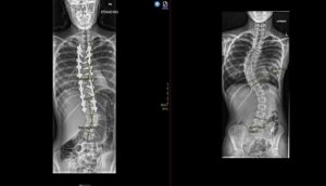 Ontario’s First Pediatric Patient Receives Robotic Spinal Surgery Ontario’s First Pediatric Patient Receives Robotic Spinal Surgery