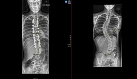 Ontario’s First Pediatric Patient Receives Robotic Spinal Surgery Ontario’s First Pediatric Patient Receives Robotic Spinal Surgery