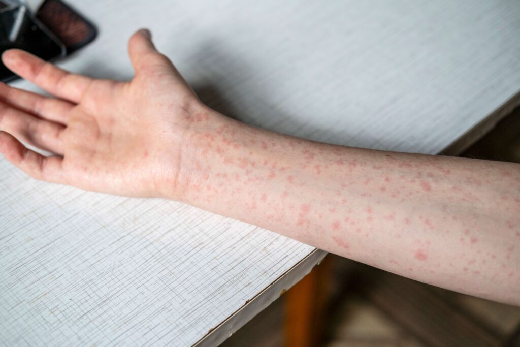 Huron-Perth Sees Highest Measles Cases in Ontario